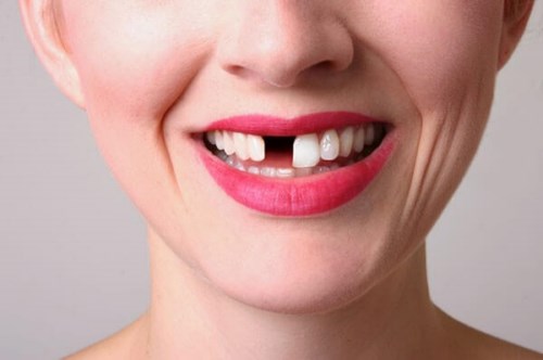 Nhổ răng khi niềng: “1001 nỗi trăn trở” được chuyên gia “gỡ rối”